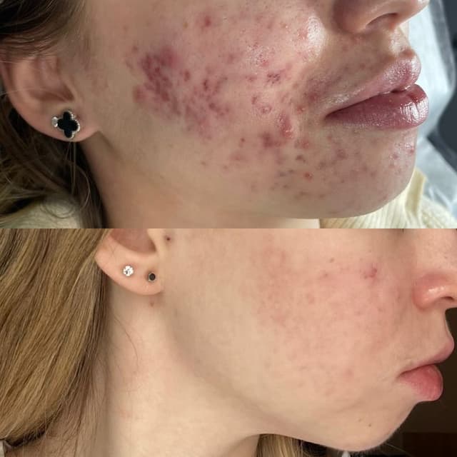 Acne Boot Camp at GLASS SKN+ in Gresham, OR
